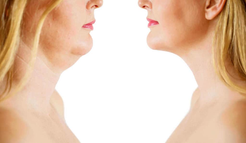 Double Chin treatment Bridgend before and after results