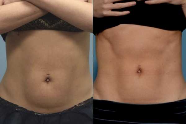 body sculpting FAQs Bridgend