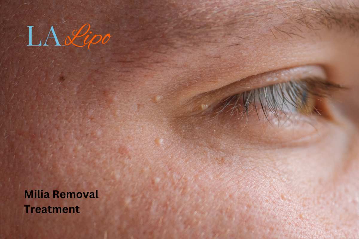 Cryopen Milia Removal: Is It the Easiest and Safest Option Bridgend?