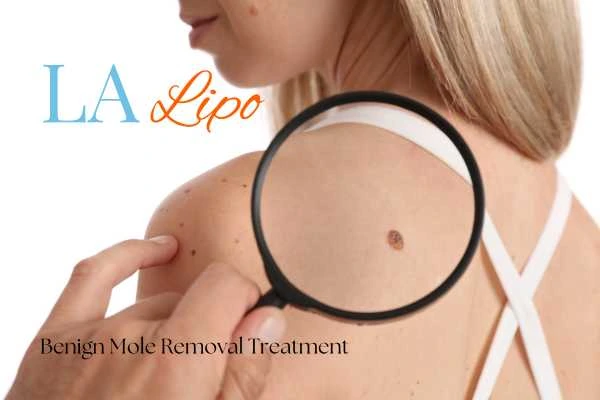Why getting moles removed Bridgend can boost your confidence!