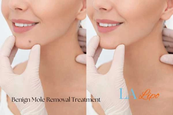 Woman's before and after results of being moles removal treatment Bridgend