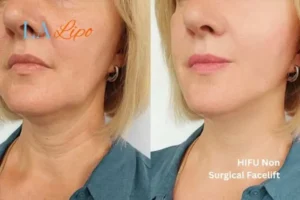 hi-fu for wrinkles Bridgend before and after results