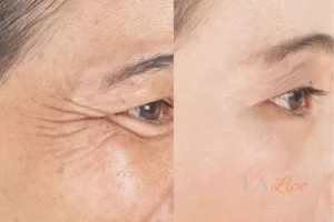 Before and after results of woman - HI-fu wrinkles reduction treatment Bridgend