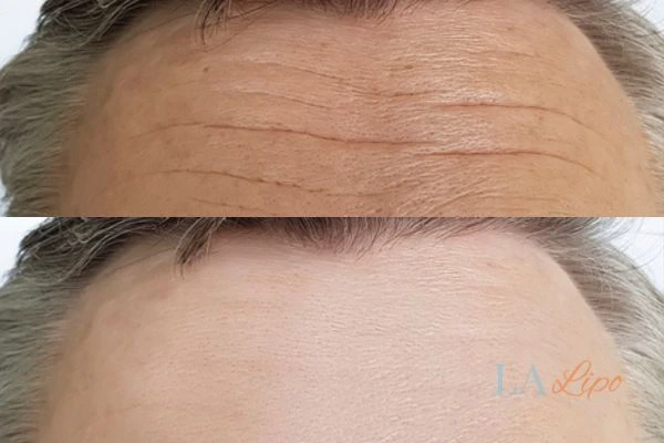 results of HIFU Bridgend on mans forehead to help reduce lines and wrinkles