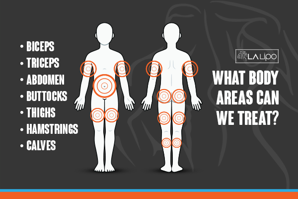 Graphic to show areas you can have LA-EMS Body Sculpting Bridgend treatment.