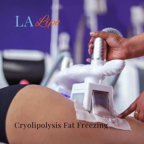fat freezing - Cryolipolysis Bridgend