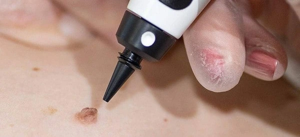 skin tag removal using cryopen Bridgend