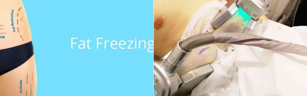 Fat freezing Bridgend on multiple areas of the body