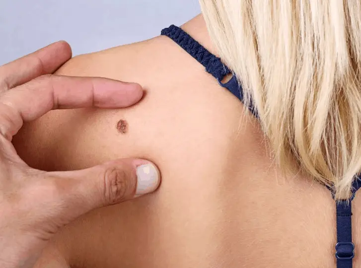 woman having mole removal Bridgend consultation before treatment.