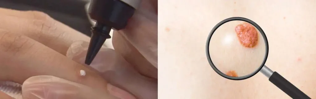 Cryopen for mole removal Bridgend - speak to our team today!