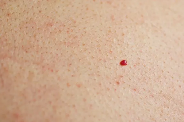 close up of a cherry angioma Bridgend