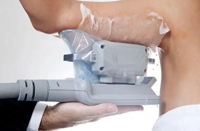 Picture of fat freezing Bridgend on the upper arms.