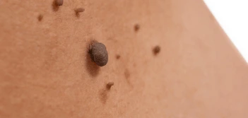 image of a skin tag Bridgend