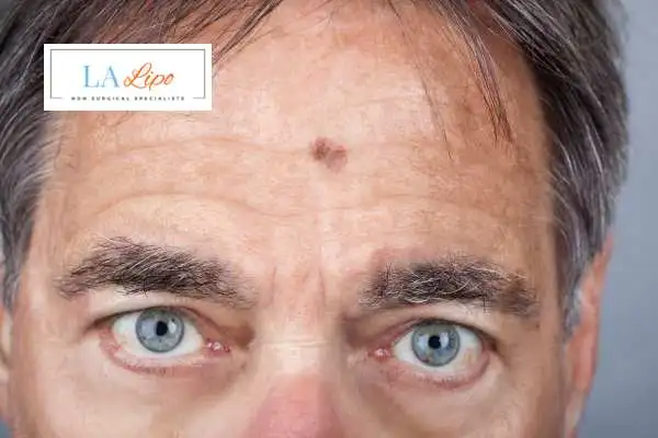 Solar Lentigo Removal Bridgend image of man with mark on his forehead