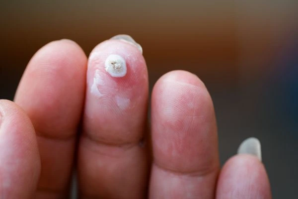 wart on person finger - cryotherapy to treat from LA LIPO Bridgend