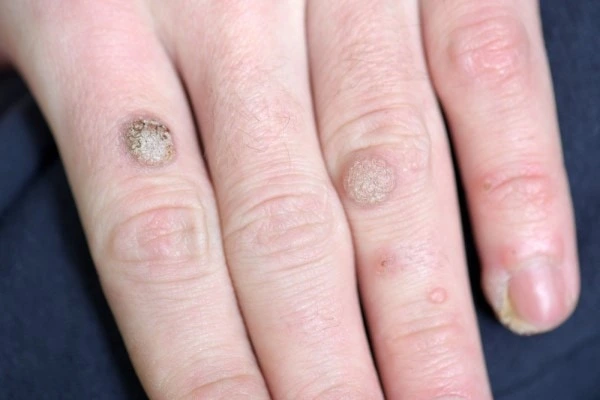 photo of warts on person hand - see wart removal Bridgend from LA LIPO