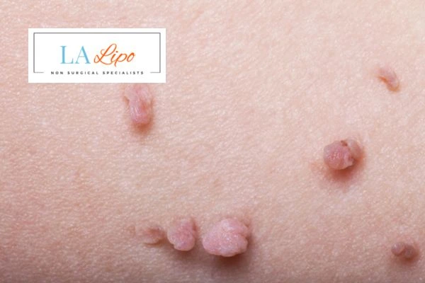 Does cryopen skin tag removal Bridgend hurt? Find out now call our team today!