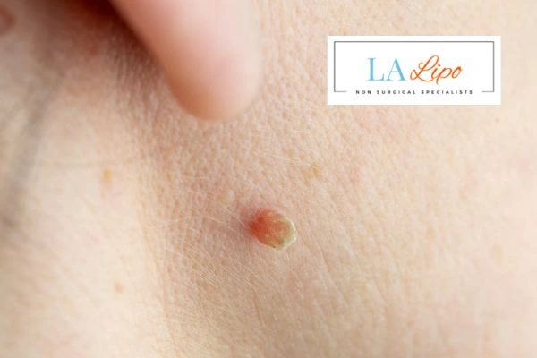 Book skin tag removal Bridgend today speak to our team now!