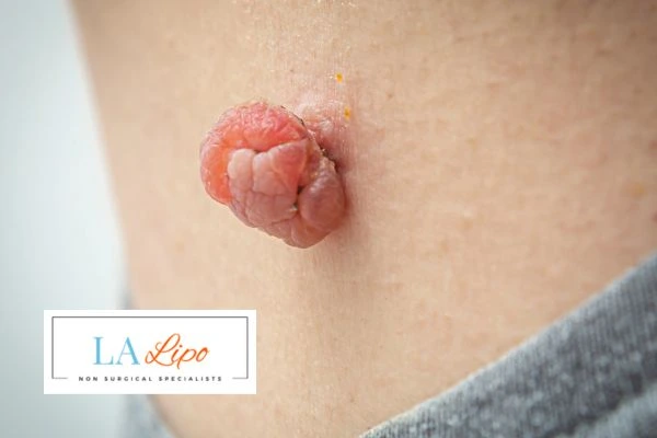 Interested in skin tag removal Bridgend? Concerned about the pain? Find out more today!