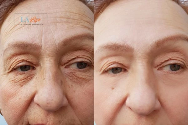 The powerful benefits of Morpheus8 Treatment Bridgend - Call Our team today!