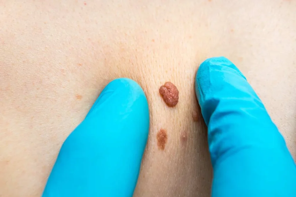 LA LIPO Cryopen Lesion Removal Prices Bridgend
