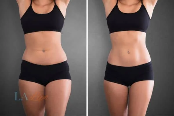before and after results of non-surgical treatment to help a woman's body image and mental health Bridgend