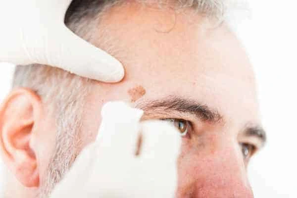 Age spots and elderly people Bridgend what is the link?