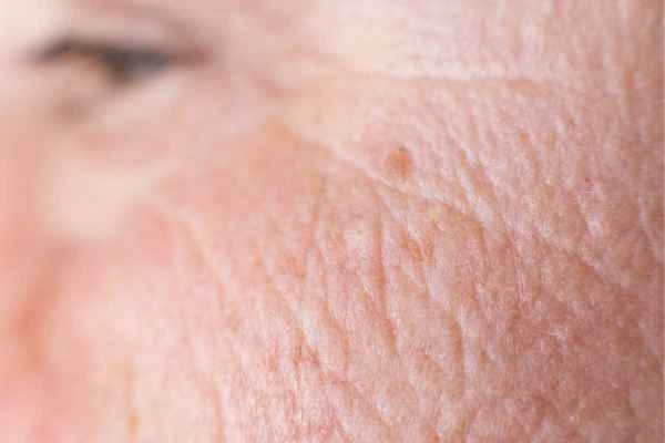 close up picture of a woman's face showing an age spot Bridgend