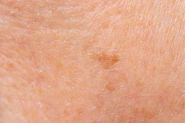close up picture of age spots Bridgend