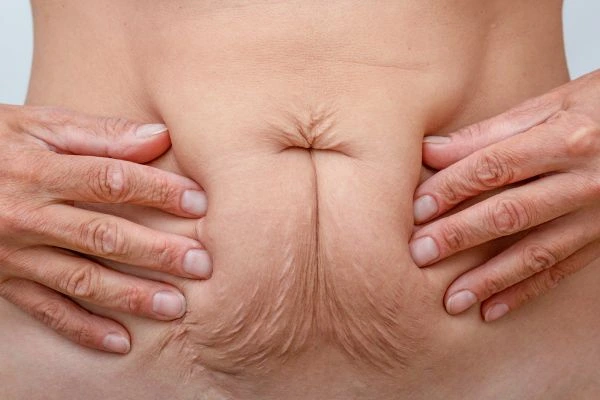 Image of a woman's stomach with loose skin - example of skin tightening Bridgend options