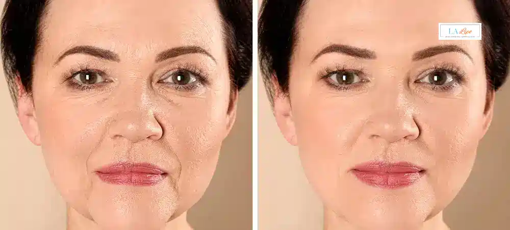 How Long Does It Take to See Results and How Long Do They Last Bridgend?