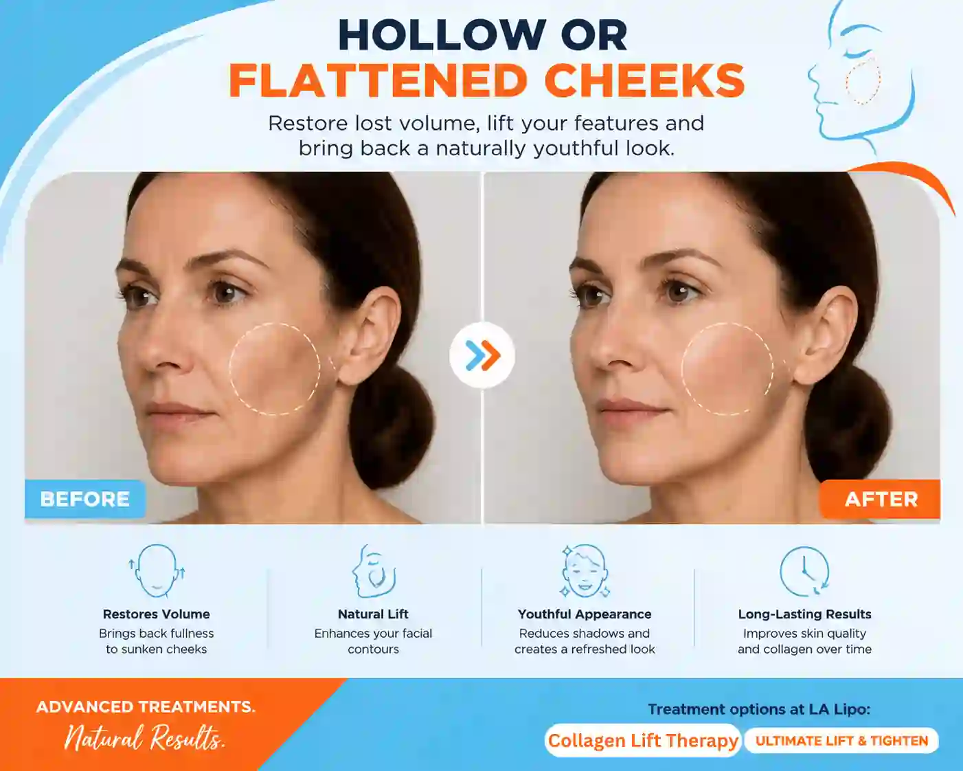 Sign #4: Hollow or Flattened Cheeks Bridgend