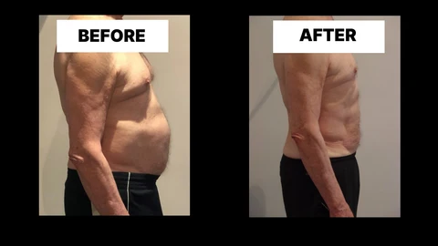 What Symptoms Can Diastasis Recti Cause in Men? Weak Core, Back Pain and Poor Posture Bridgend